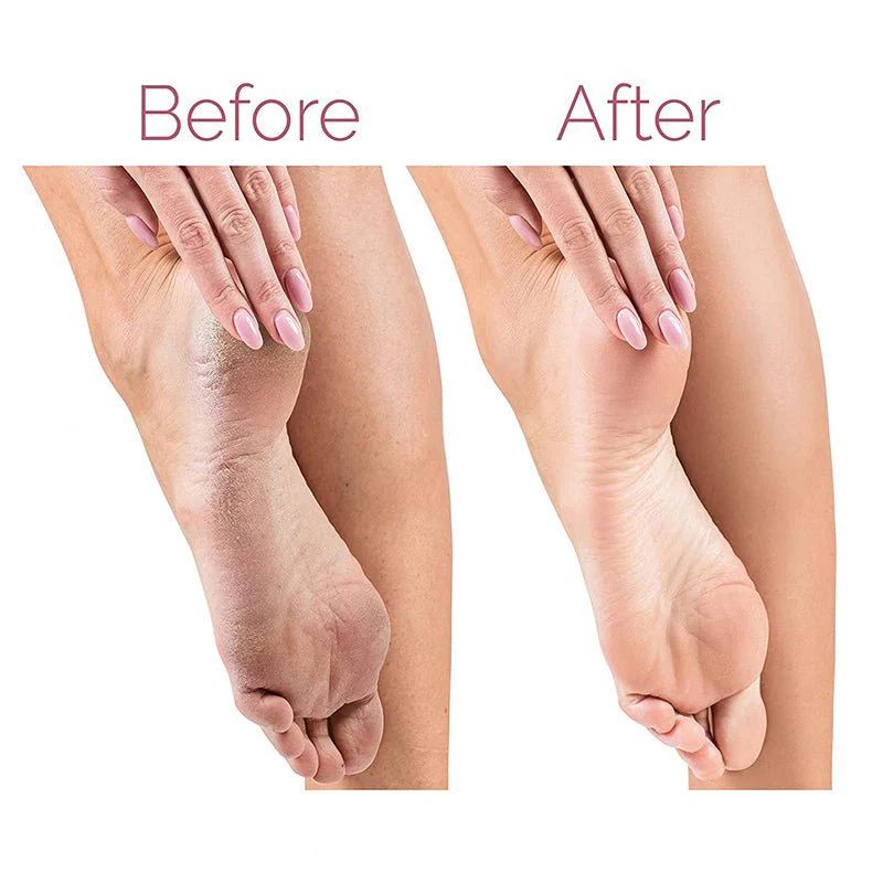 Electric Pedicure Foot || Callus Remover